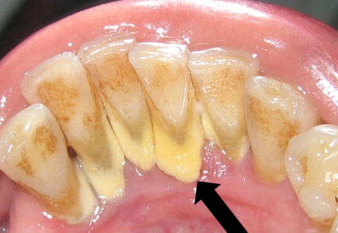 Lấy Cao Răng Mất Bao Lâu? Khi Nào Nên Đi Lấy Cao Răng